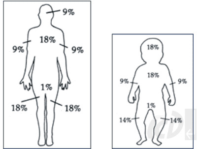 Oparzenia, opatrunki WaterJel - ICD.pl - Wyposażenie ... rule of 9s diagram 
